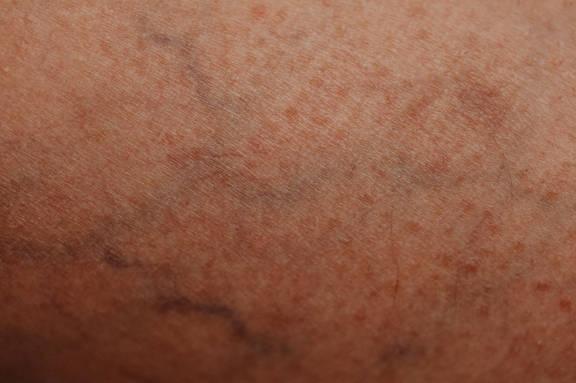 手臂上清晰可见的蓝色静脉
